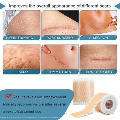 Silicone Gel Scar Relief Patch Csection